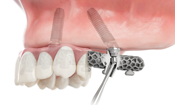 Dental Implant Systems: Discover now! | Dentsply Sirona India